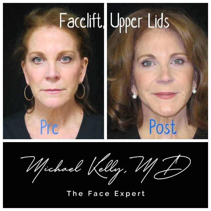 Fat grafting is a facelift essential, creating a natural, rejuvenated look